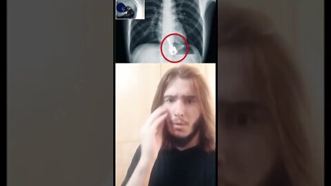 Άνδρας έφαγε τα κλειδιά του