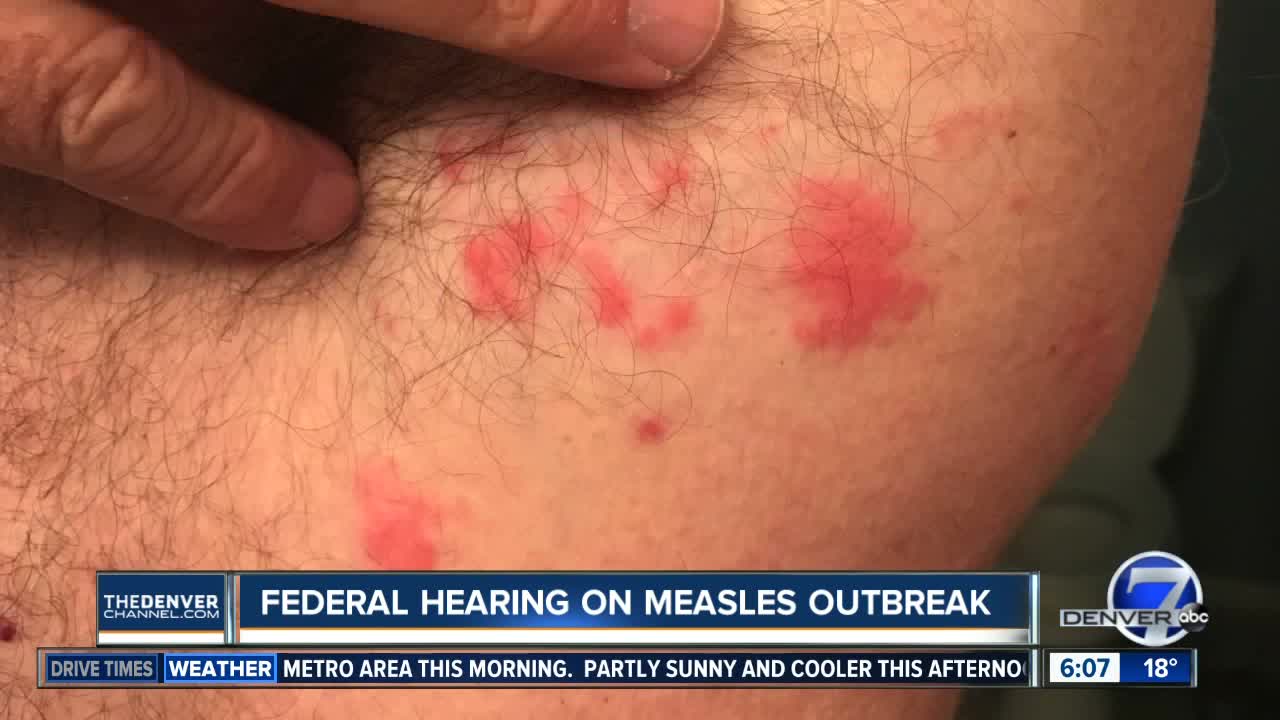 Rep. DeGette leads hearing on measles outbreak and vaccinations