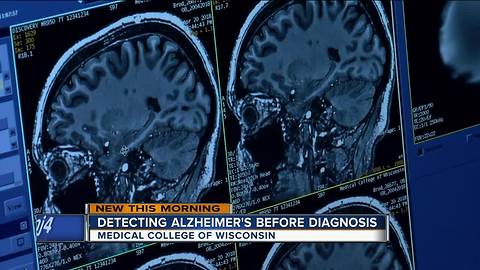 Medical College of Wisconsin looking for volunteers in Alzheimer's research