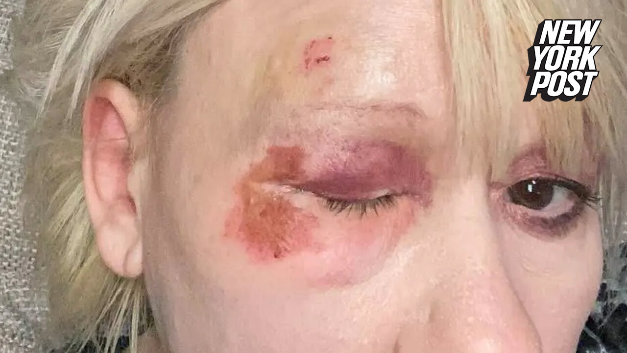 Slain Georgia mom Debbie Collier shared pics of black eye after 'fall'