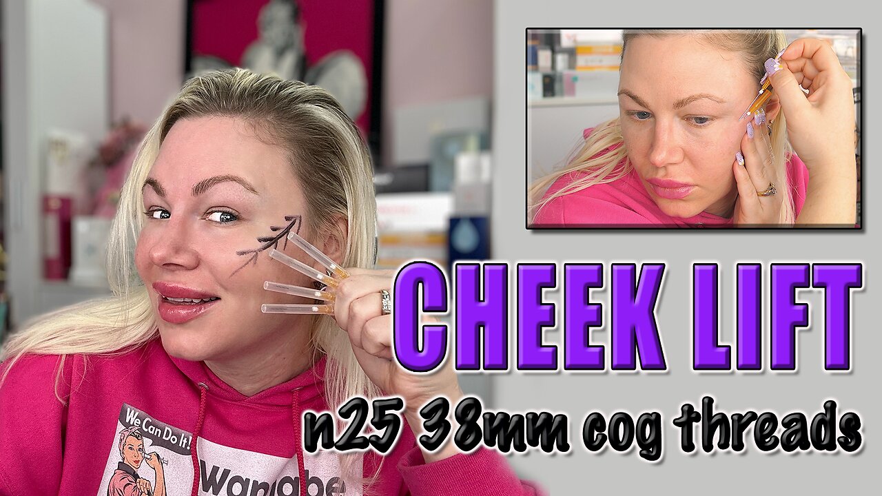 Cheek Lift with N2538mm Cog Threads, AceCosm | Code Jessica10 Saves you money