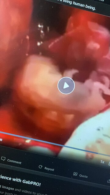 Genocide of 73 million babies each year