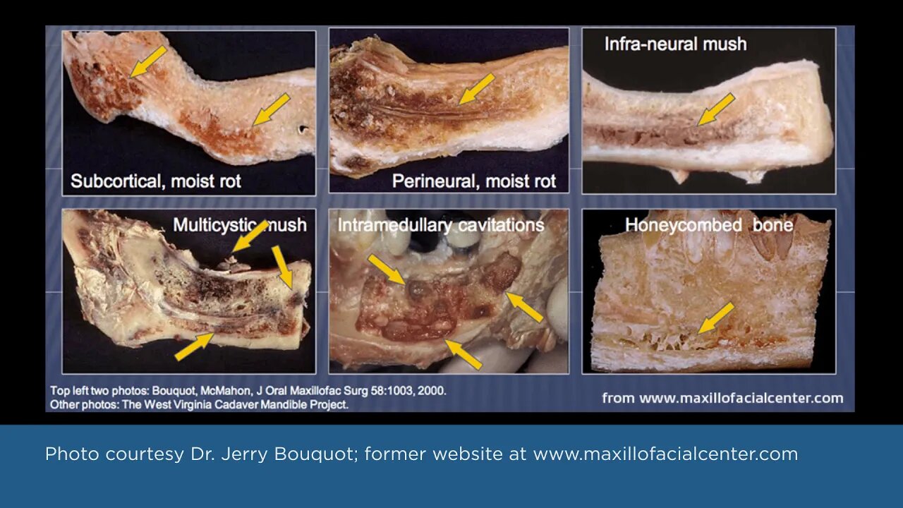 Ischemic Osteonecrosis in the Jaws