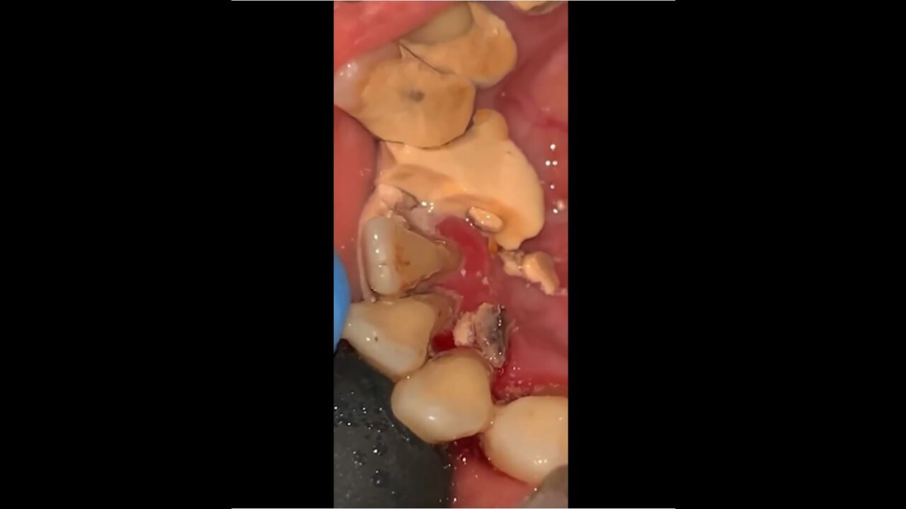 Removing Tartar from Teeth