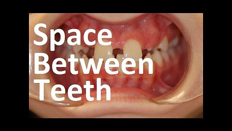 Causes & Orthotropics Treatment of Gaps Between Teeth (Diastema) by Prof John Mew