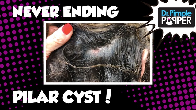 A Never Ending Pilar Cyst