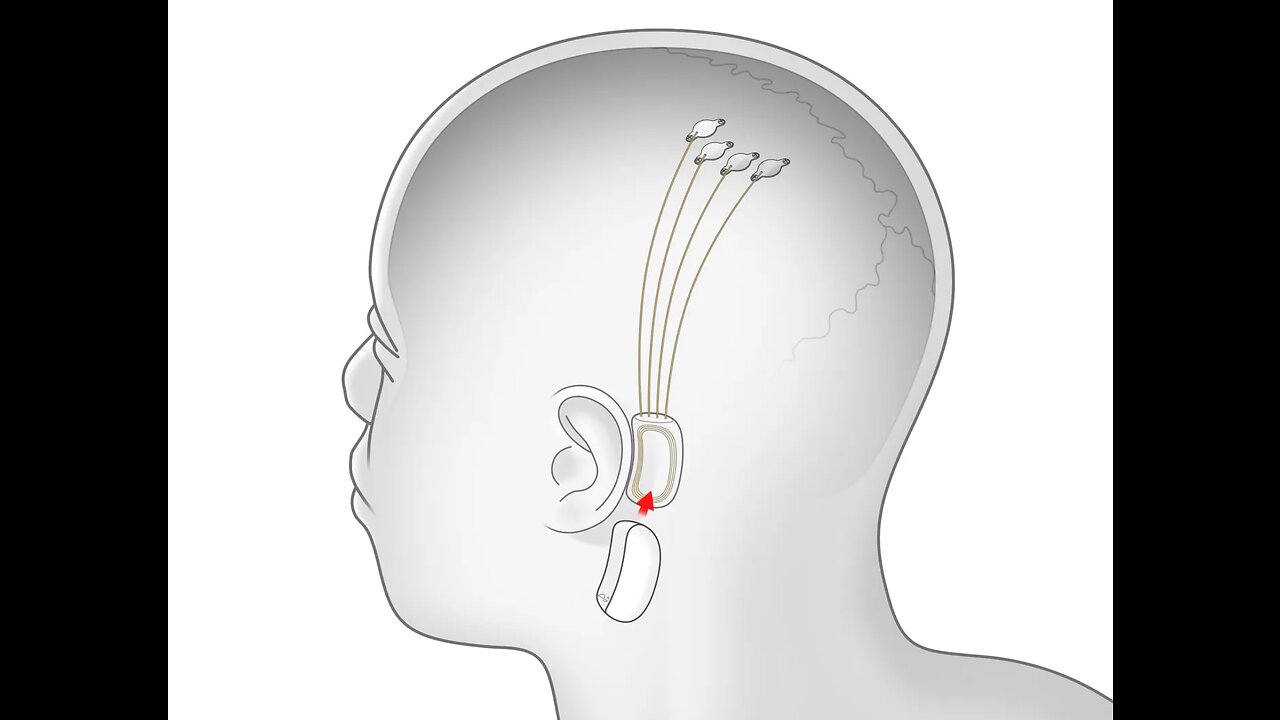 Neuralink Gets Approval for Human Clinical Trials