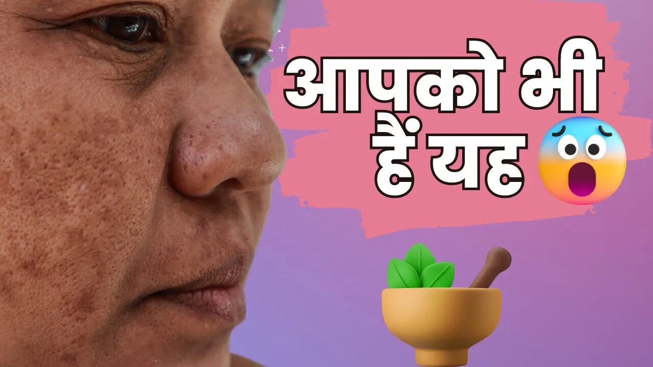 The Top 5 Causes of Pigmentation and How to Prevent Them | Hindi