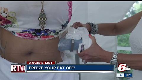 Angie's List: Freeze your fat off