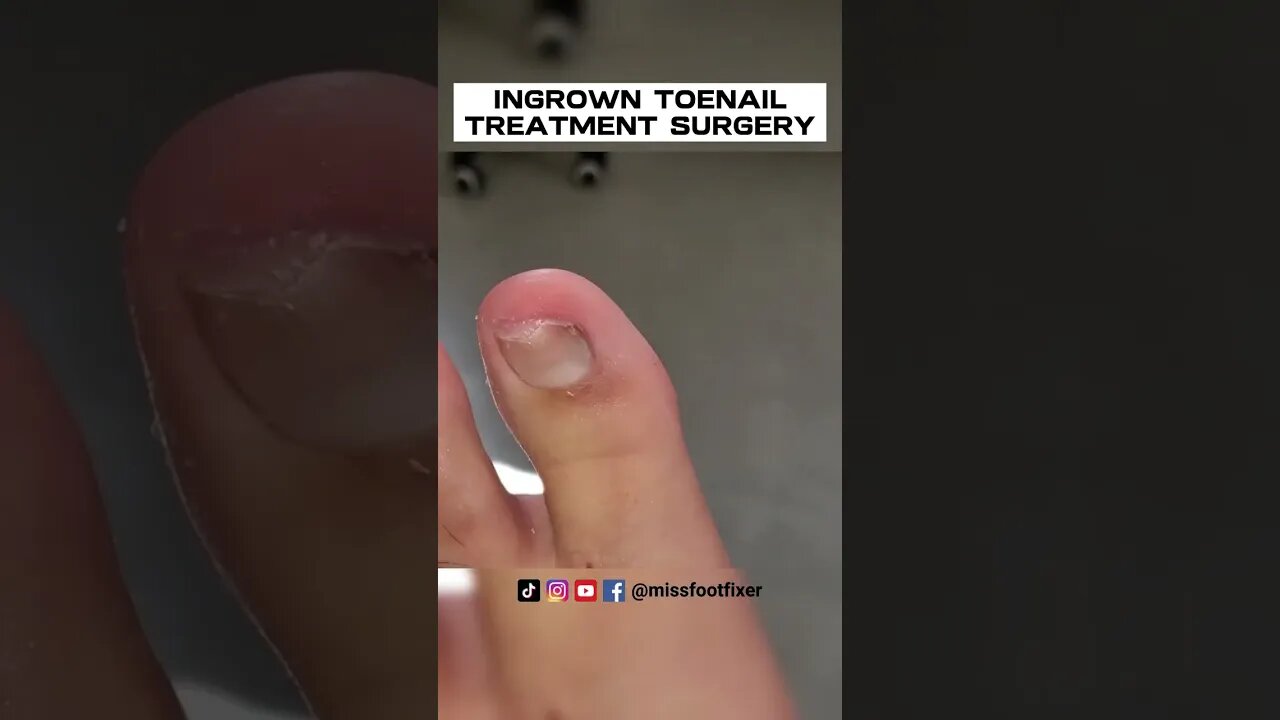 QUICK TREATMENT : INGROWN TOENAIL TREATMENT SURGERY BY FAMOUS PODIATRIST MISS FOOT FIXER