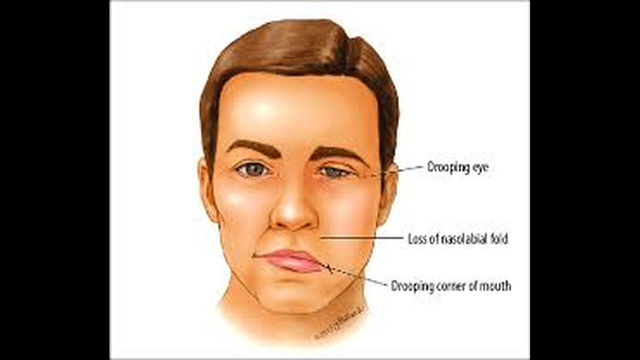 Bell's Palsy - What you need to know