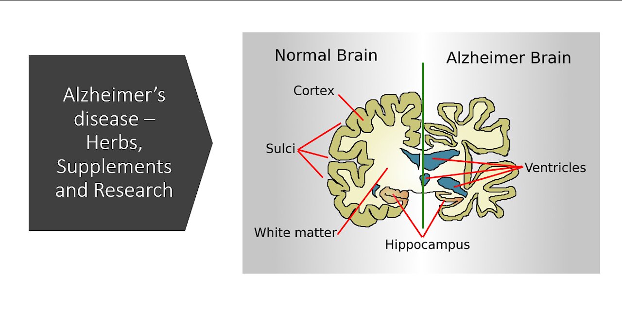 Alzheimers disease - herbs, supplements & nutrients