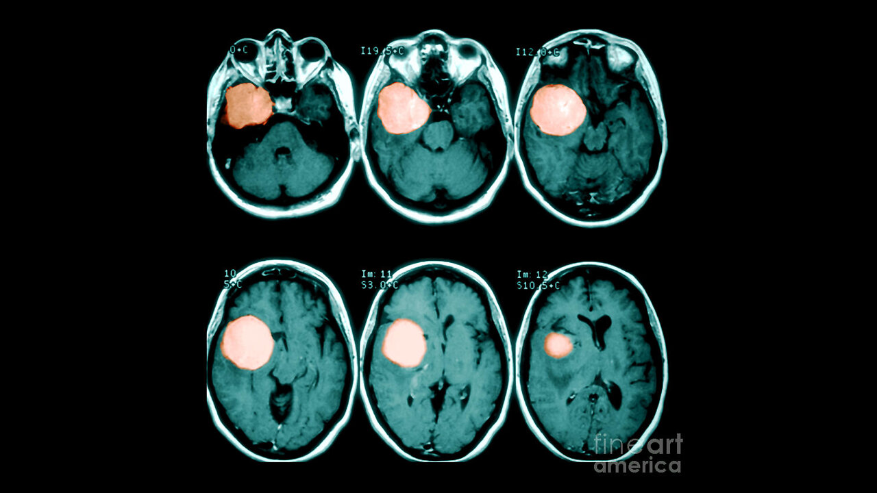 Treating Tumors with Chlorine Dioxide (Animals AND Humans)- "The Testimonial" Edition 2022.11