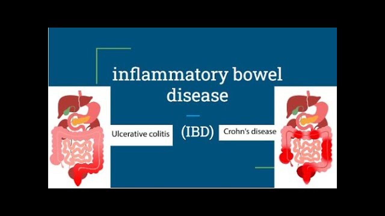 Inflammatory Bowel Disease ( CROHN's Disease and Ulcerative Colitis) Its Diagnosis and Treatment