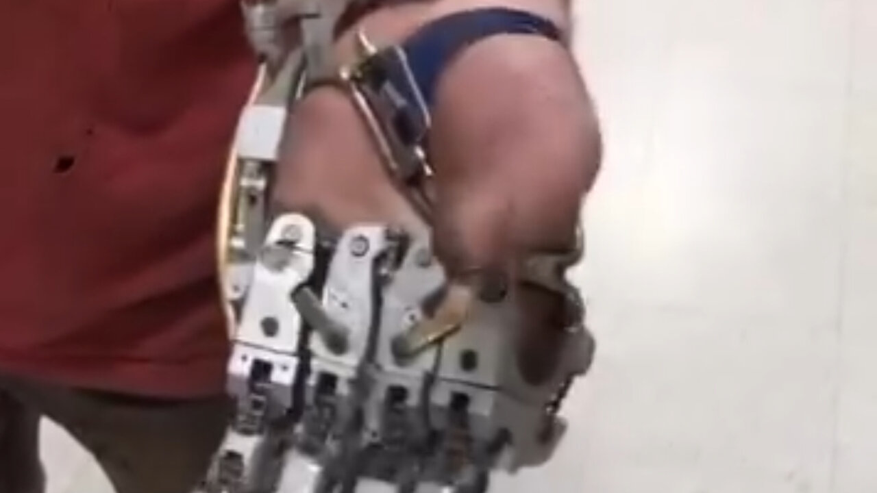 A man who lost his fingers in an accident found a unique way to get most of his functions back