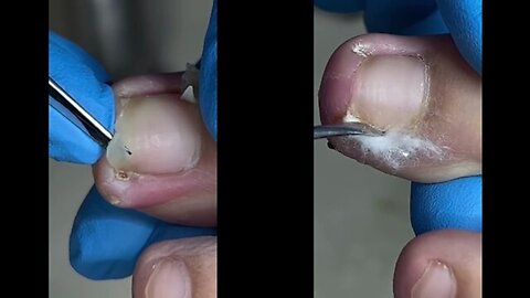 Satisfying Toenail ingrown removal #1