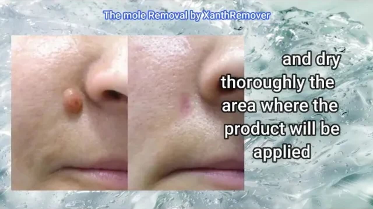 Mole Removal, Benign mole, Easy & Safe removal solution at home using 70% Glycolic Acid Peel