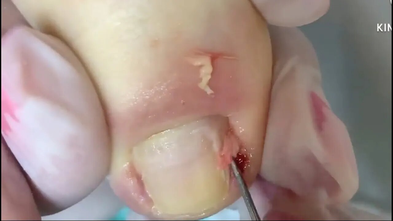 Cuidado! Imagens fortes: remoção de unha encravada #ingrown_toenail #unhaencravada #podologia