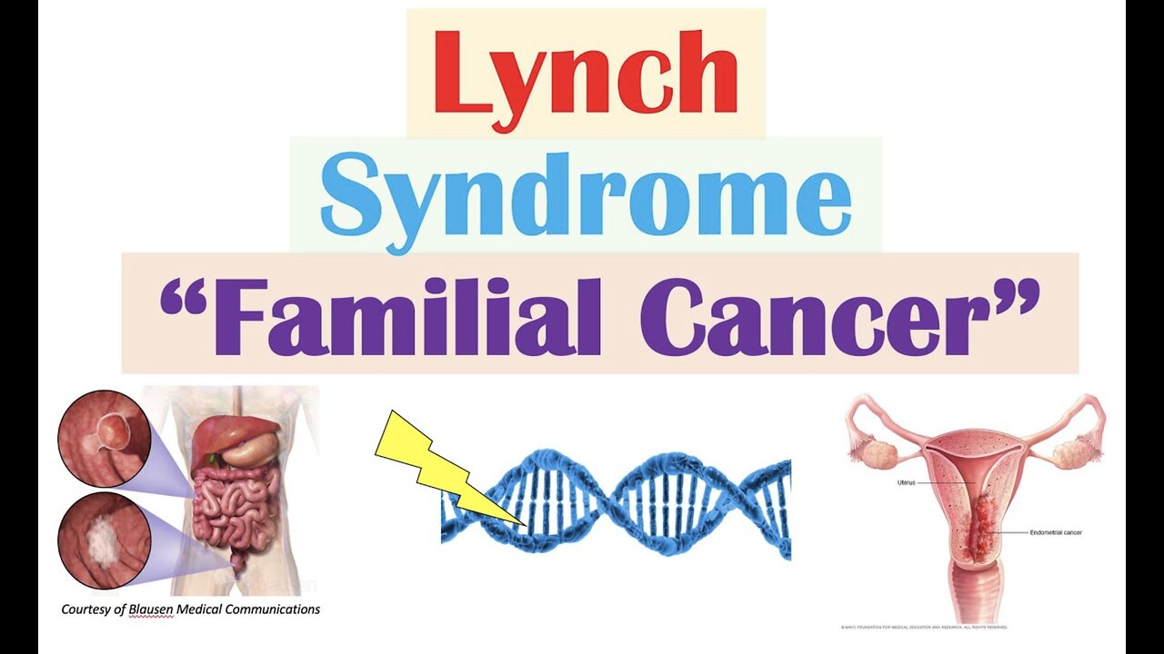 Lynch Syndrome (Hereditary Non-Polyposis Colorectal Cancer) Genetics, Symptoms, Diagnosis, Treatment