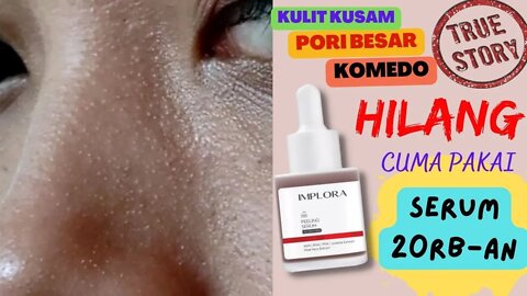 TRUE STORY : CUMA PAKAI IMPLORA PEELING SERUM PORI BESAR DAN KOMEDO HILANG