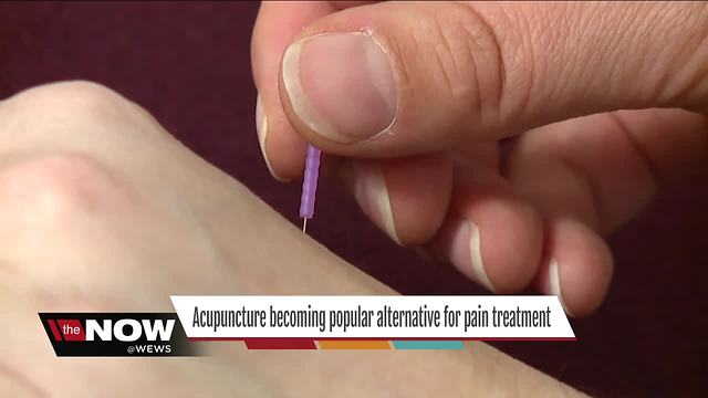 Acupuncture for pain: Ancient medicine may hold the key to solving the opioid epidemic