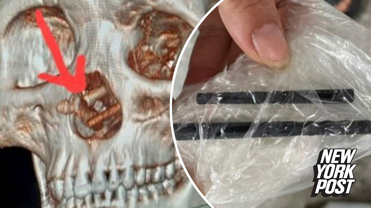 Man who suffered headaches for 5 months learns he had chopsticks stuck in his brain