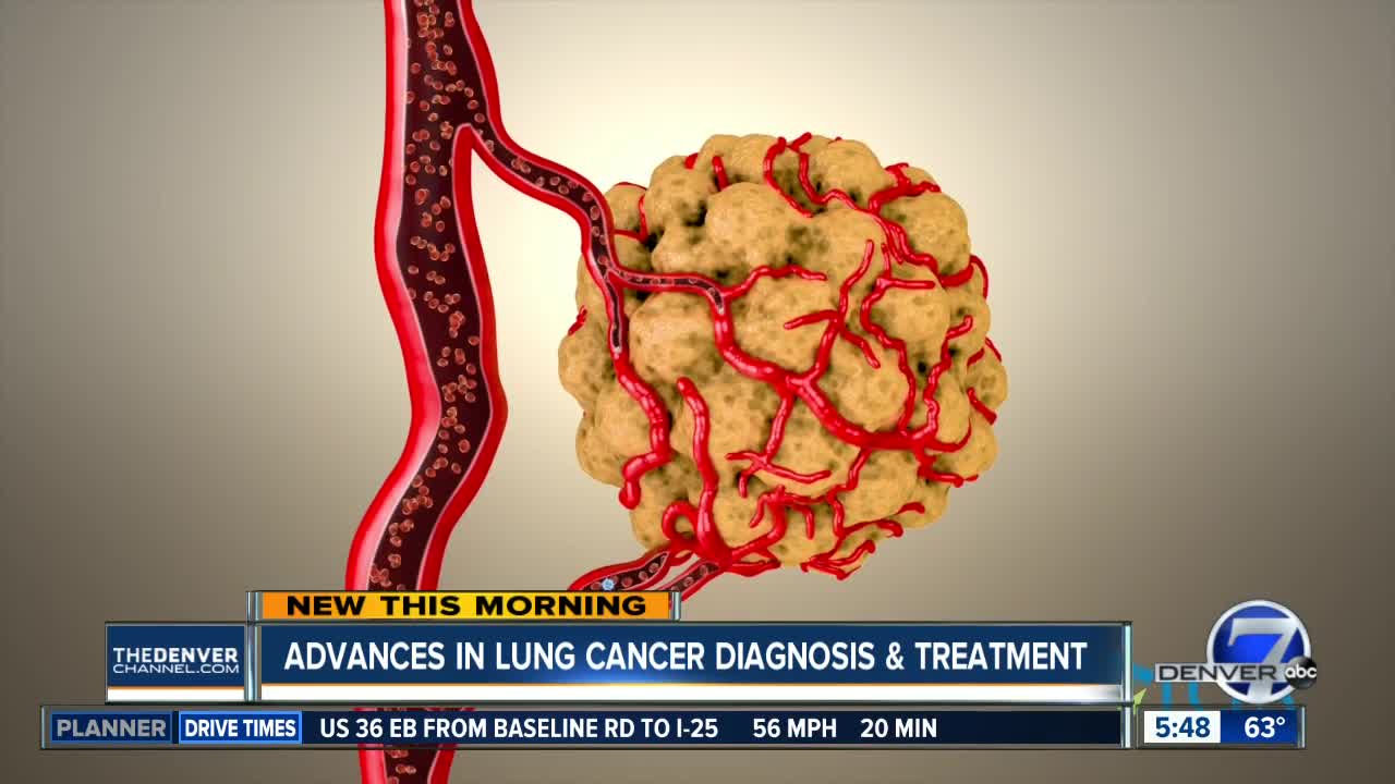 Advances in lung cancer diagnosis