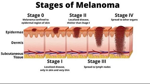 Is Stage 4 Cancer is curable? watch this!