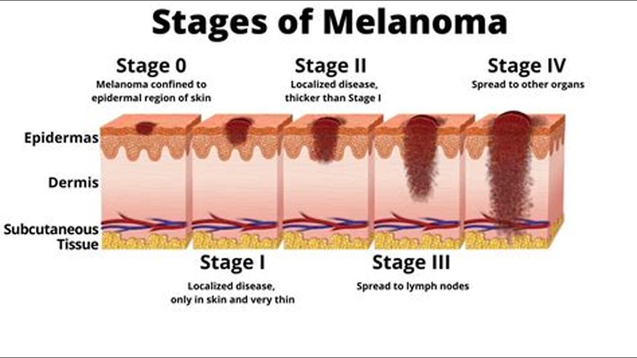 Is Stage 4 Cancer is curable? watch this!
