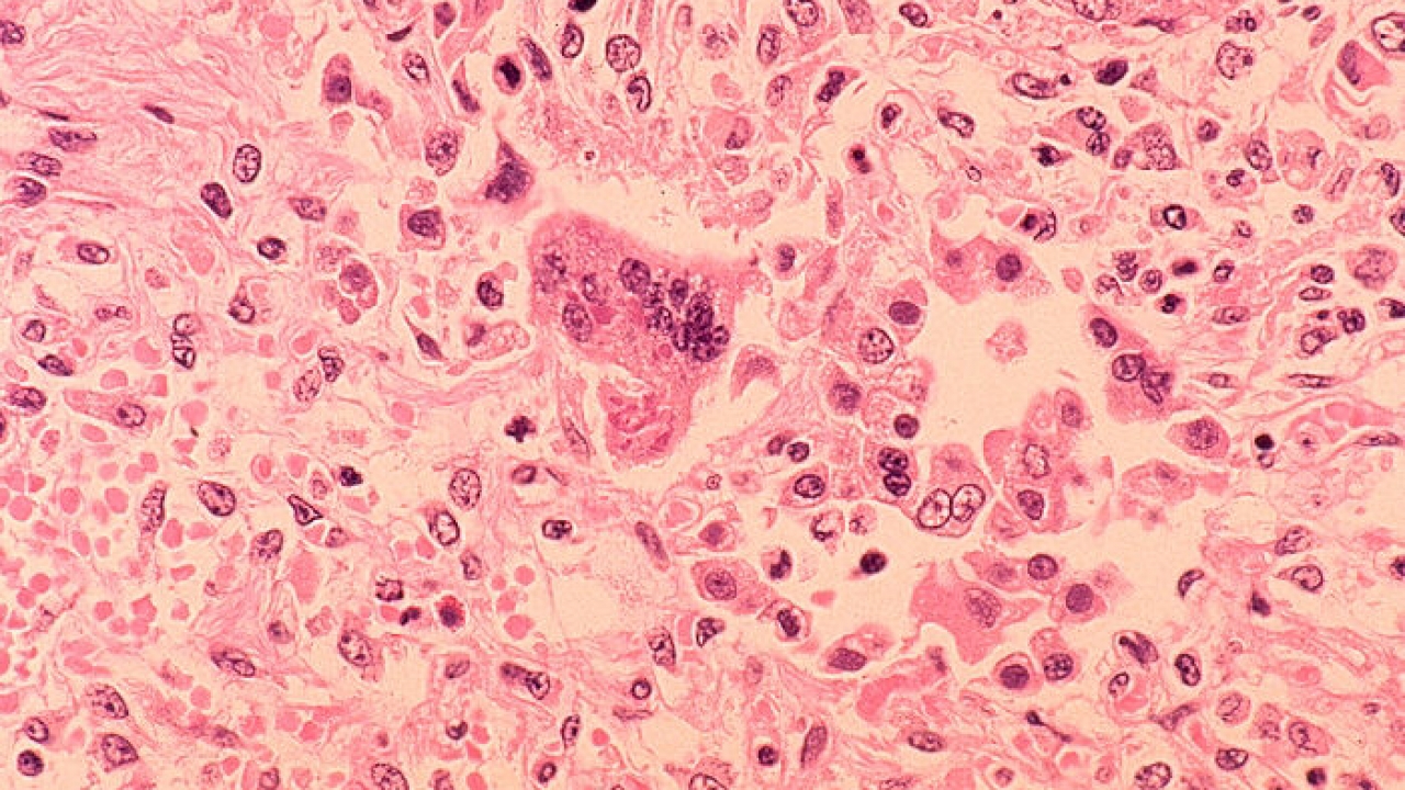 Officials Declare Measles Outbreak Over In Clark County, Washington