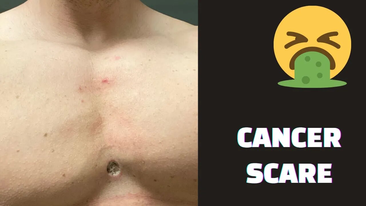 I Got Cancer Again - What This Means For My Career and Bodybuilding