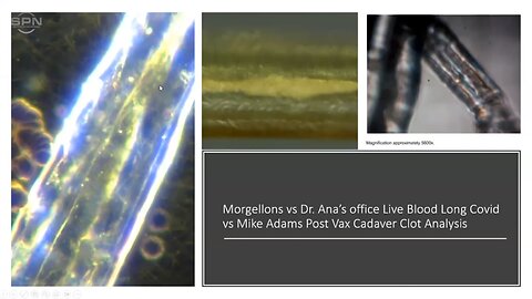 Dr. Ana Mihalcea - Uninjected Have Same Nanotech, Clots, Graphene as Injected