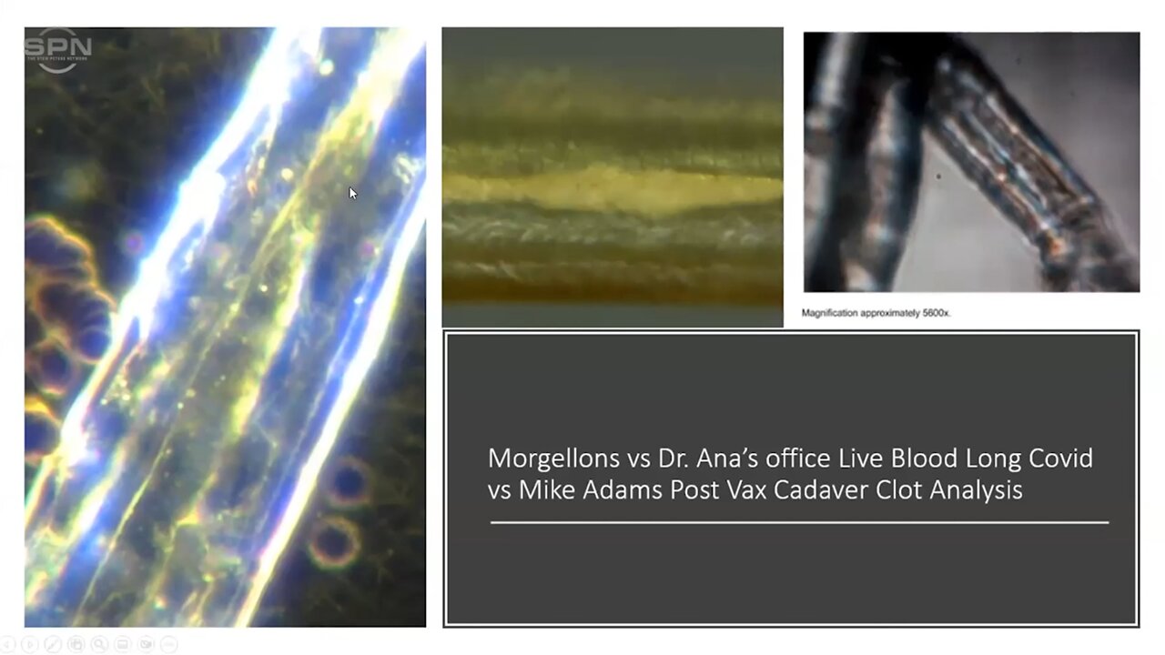 Dr. Ana Mihalcea - Uninjected Have Same Nanotech, Clots, Graphene as Injected