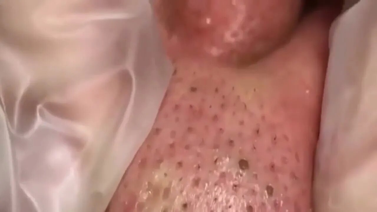 Só Relaxe Cravos e Espinhas - Remove Squeezing Blackheads and Pimples - Just Relax | Apenas Relaxe