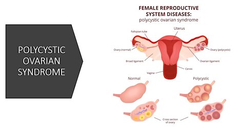 PCOS - Polycystic Ovarian Syndrome - Natural Treatment