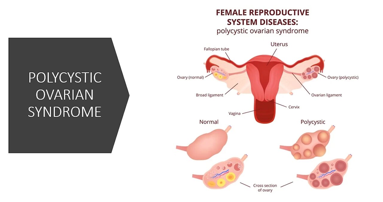 PCOS - Polycystic Ovarian Syndrome - Natural Treatment