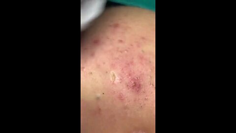 Blackheads episode 12