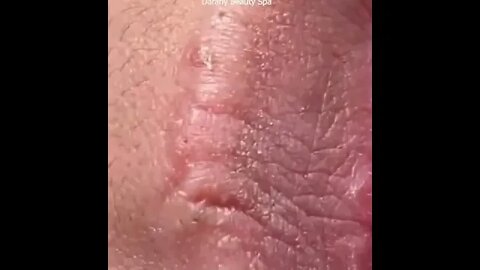 Blackheads on lip ✨