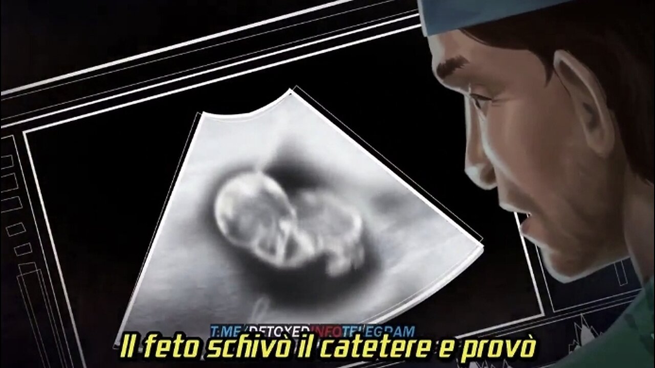 NWO, DEPOPOLAZIONE: Aborto, La Procedura, CHOICE42
