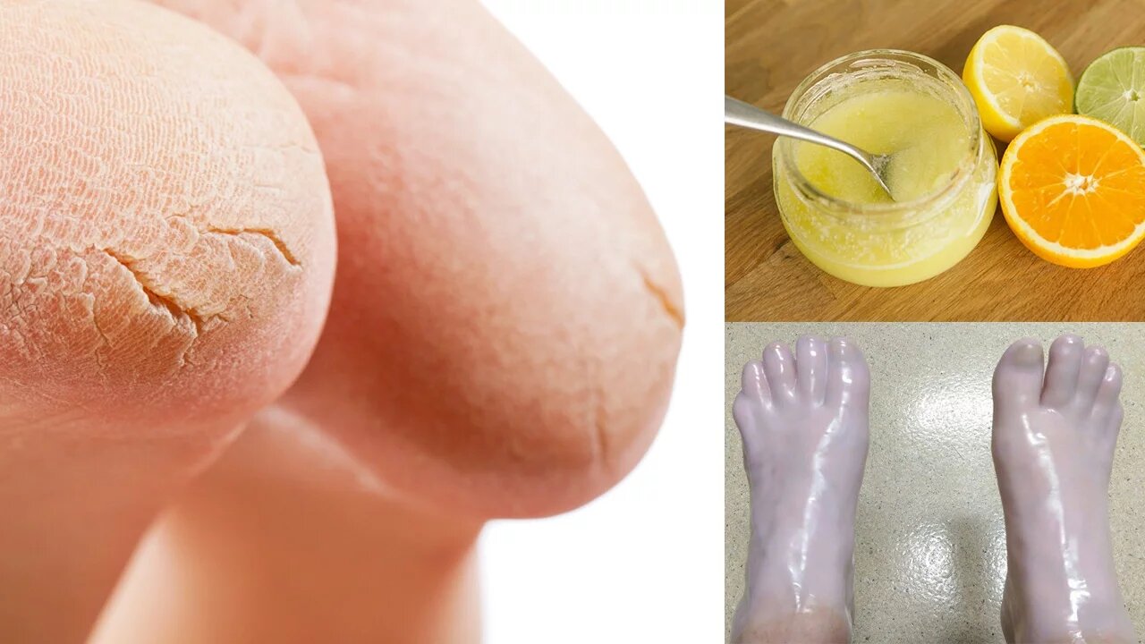 10 Simple Home Remedies For Cracked Heels