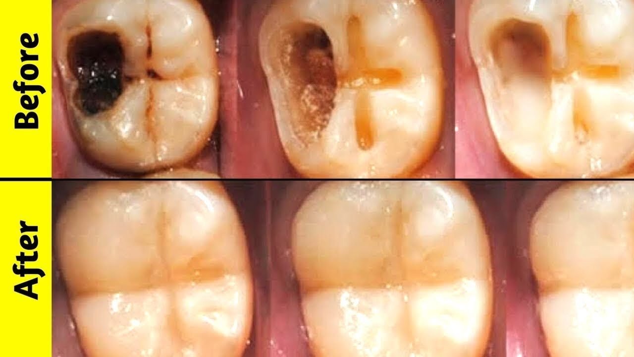 Doctor : how to get rid of cavities