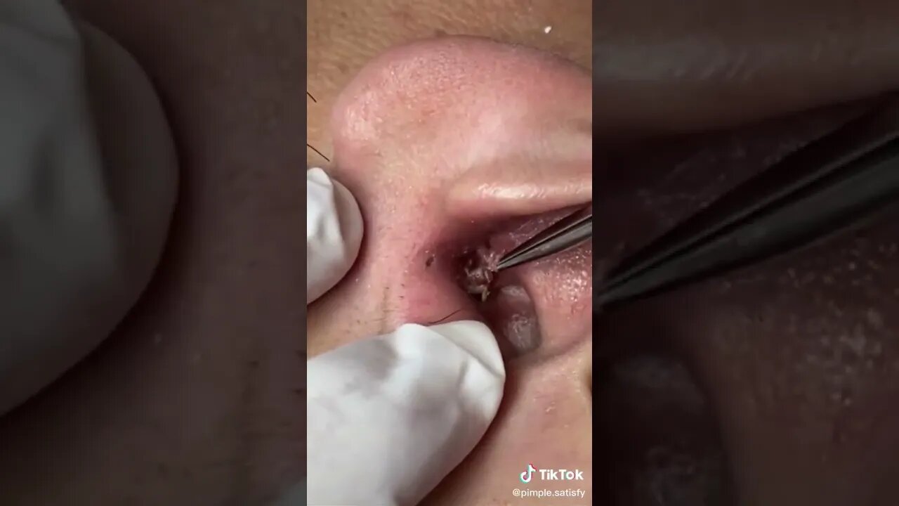 Huge blackhead removal in ear 👂🫣 painful to watch #blackheadremoval #blackhead #blackheads #fyp