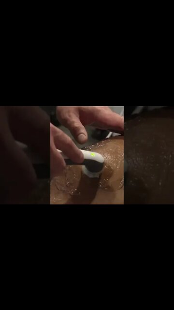 ULTRASOUND USED ON Lifter's Torn Quad 🤔❓