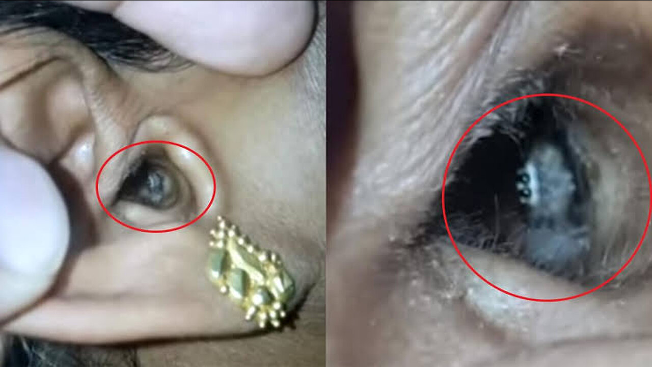Removing a huge insect stuck in ear of little girl