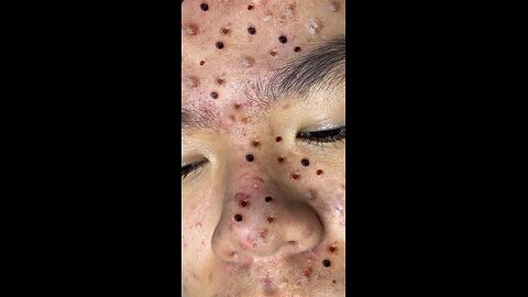 blackhead