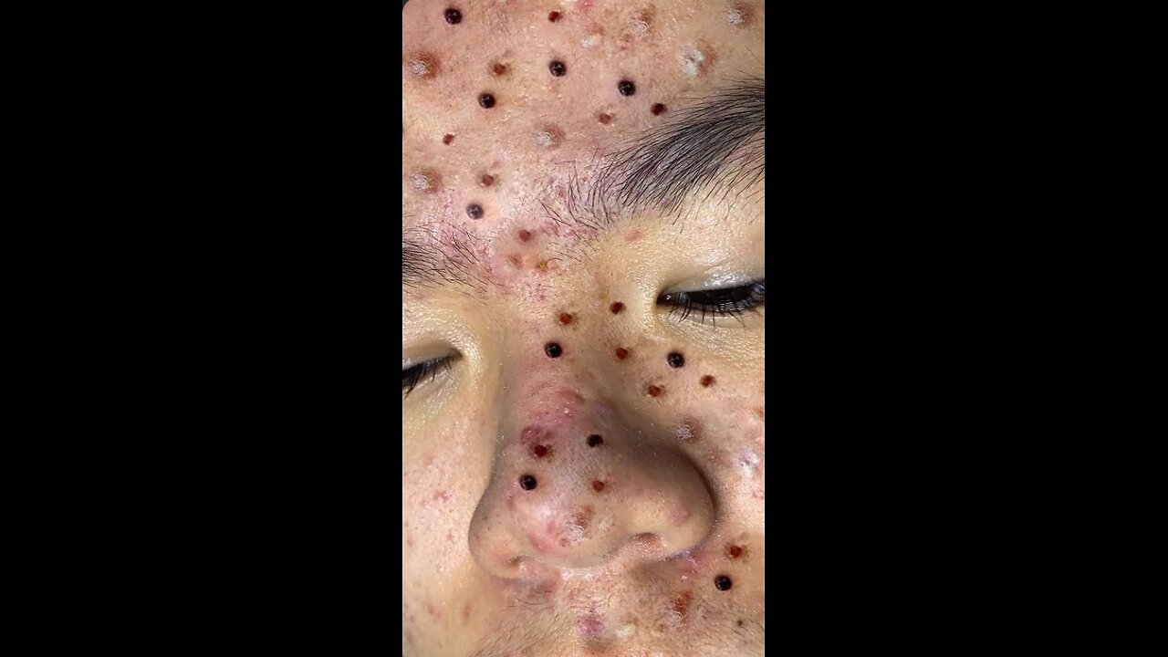 blackhead