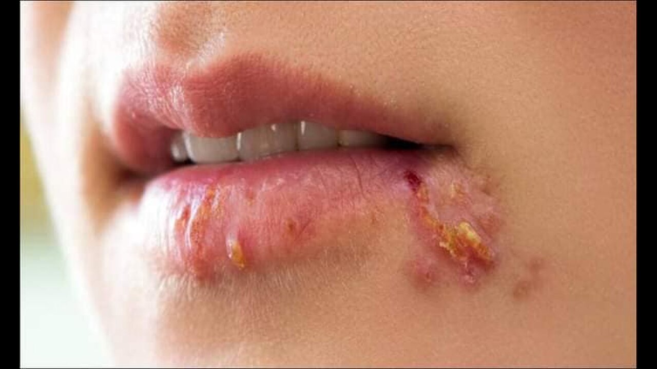 guerir du bouton de fievre en 24 heure sans creme genante