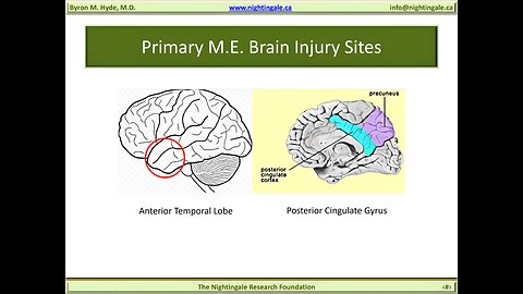 Primary "Myalgic Encephalomyelitis (M.E.)" Brain Injury Sites (Anterior Temporal Lobe, Posterior Cingulate Cyrus & Precentral Cyrus of the Primary Motor Cortex) - Byron Hyde, MD