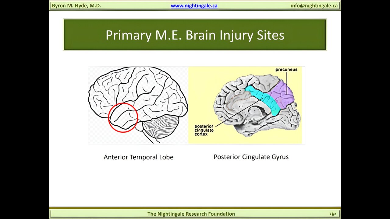 Primary "Myalgic Encephalomyelitis (M.E.)" Brain Injury Sites (Anterior Temporal Lobe, Posterior Cingulate Cyrus & Precentral Cyrus of the Primary Motor Cortex) - Byron Hyde, MD