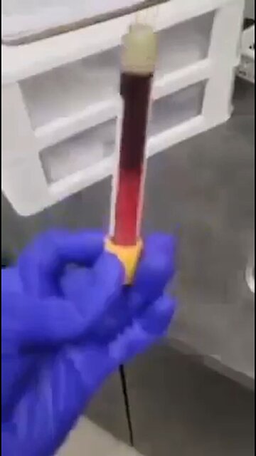 Haematologist comments on mRNA Vaccinated Blood